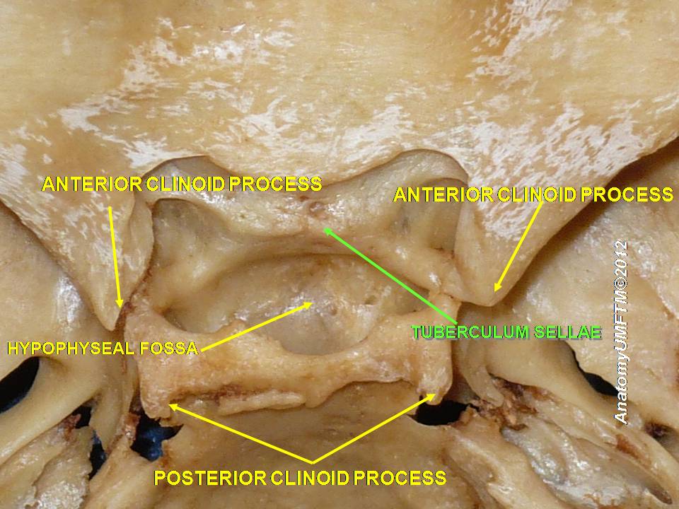 “Posterior Clinoid Process” – Anatomist90, via Wikimedia Commons. Licensed under CC BY-SA 3.0.