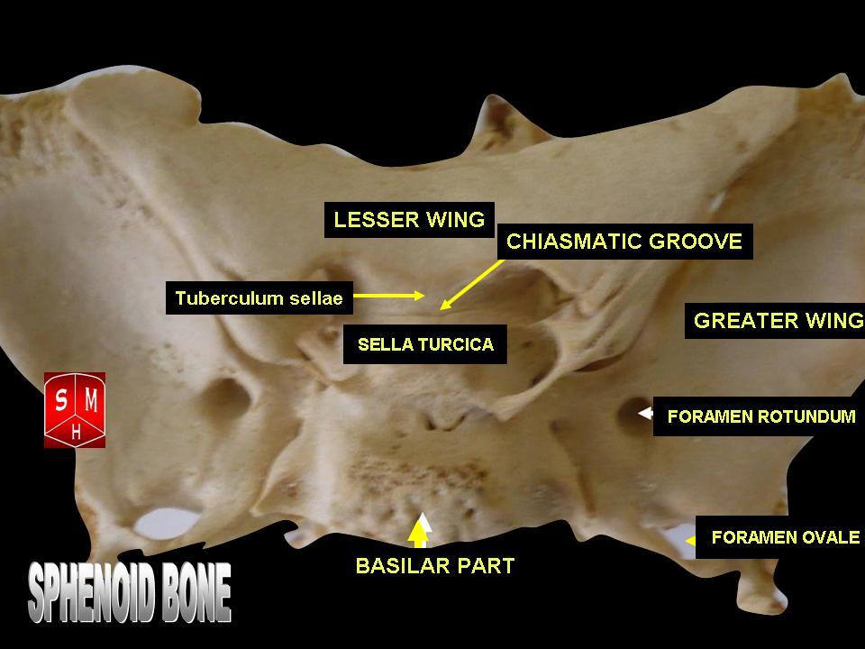 “Sphenoid bone – superior view” – Anatomist90. Own work, via Wikimedia Commons. Licensed under CC BY-SA 3.0.