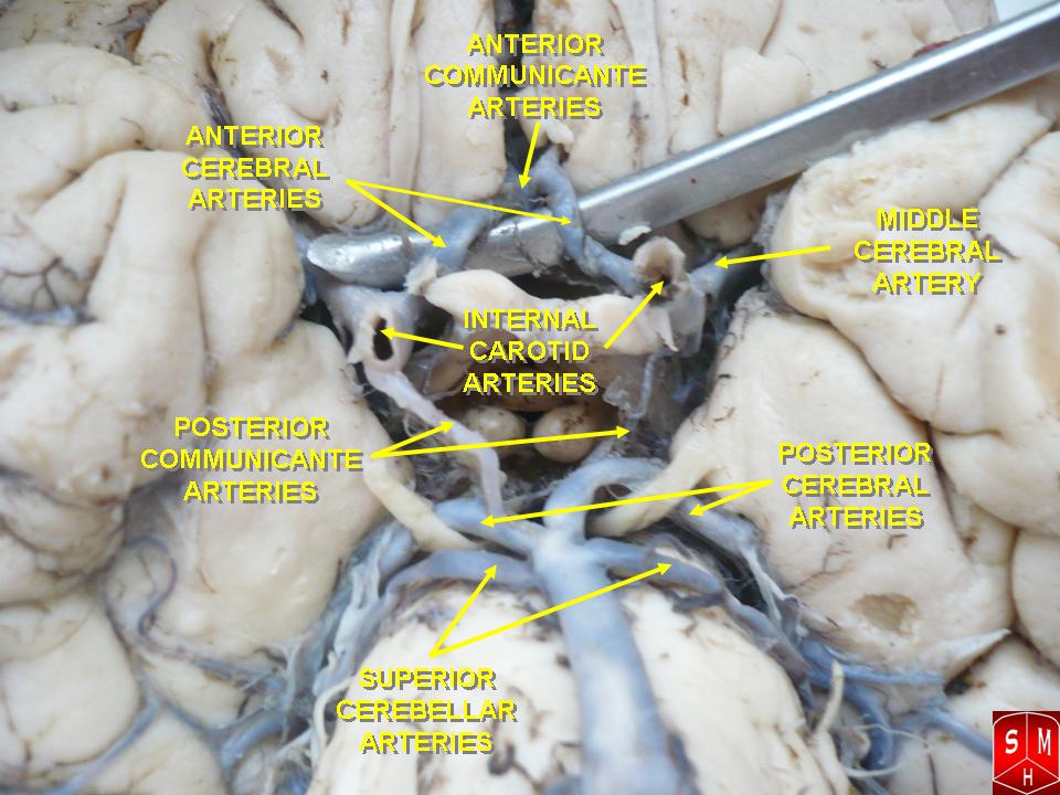 Circle of Willis – Anatomist90 via Wikimedia Commons. Licensed under CC BY-SA 3.0.