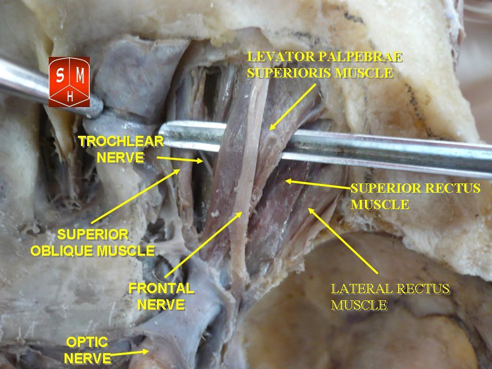 “Trochlear and Frontal nerves” – Anatomist90 via Wikimedia Commons. Licensed under CC BY-SA 3.0.